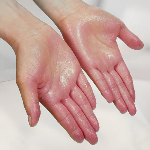 pic_hyperhidrosis_1nw_large